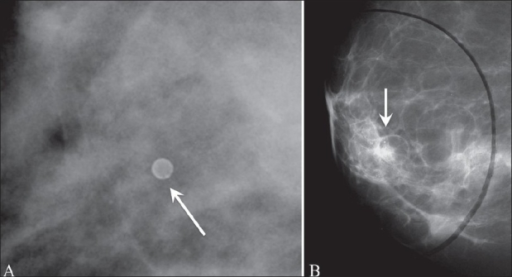 Mammogram A Shows A Lucent Centered Focus Arrow Of Open I