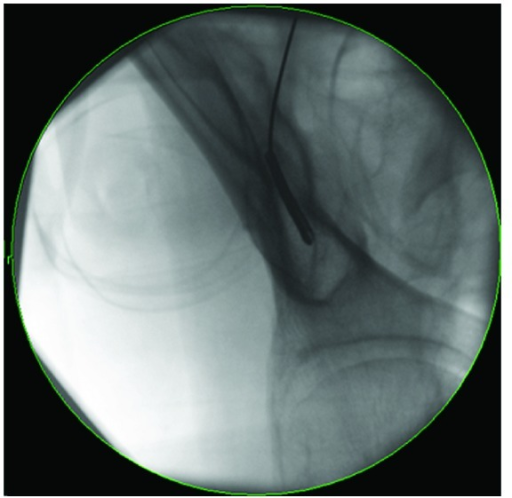 Obturator Outlet View Showing The Teardrop Target Open I