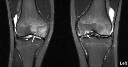 T Weighted Image With Fat Saturation Coronal Images Of Open I