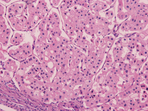 Microscopic View Of The Chromophobe Renal Cell Carcinom Open I 4690