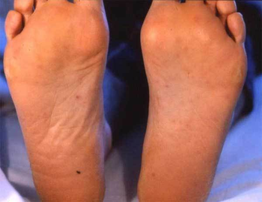 Maculopapular Rash On The Soles Of The Patient S Feet Open I My XXX