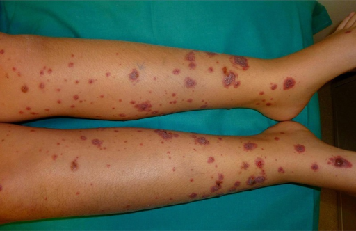 Typical Nonthrombocytopenic Palpable Purpura In The Low Open I