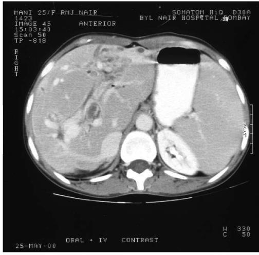 Ct With Contrast – Intrahepatic Biliary Radical Dilat 