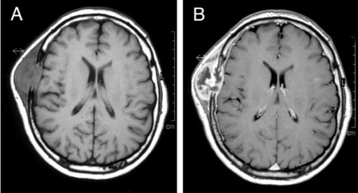 T1 Weighted MRI Of Brain Before Figure 3A And After G Open I