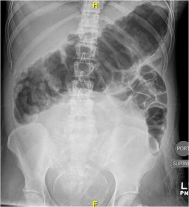 Preoperative Plain Film Abdominal Radiograph Of A 26 Ye Open I