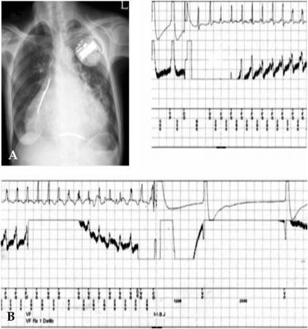 Single chamber pacemaker atrial fibrillation
