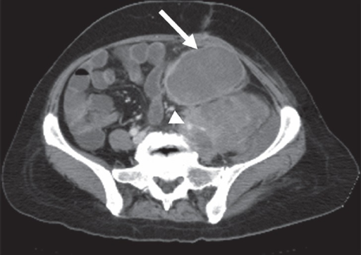 56 Year Old Woman With Leiomyosarcoma Of The Left Iliac Open I