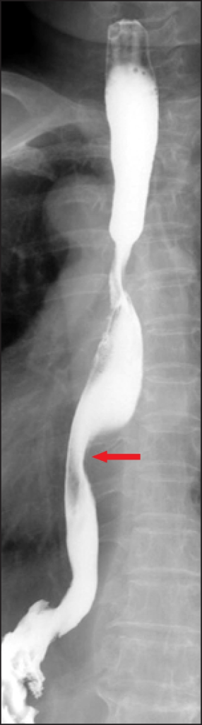 Upper Gastrointestinal Barium Study. An Upper Gastroint | Open-i