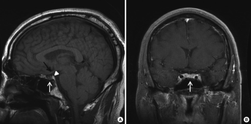 T1 Weighted Magnetic Resonance Imaging MRI At The Lev Open I