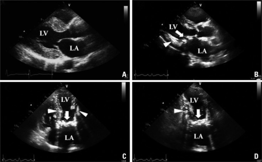 Changes of transthoracic echocardiography. The echocard | Open-i