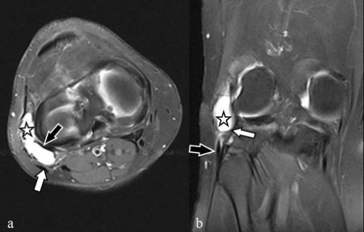 LCL Bursitis The Axial A And Coronal B Fat Saturat Open I