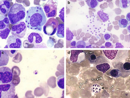 Bone Marrow Smears From Case Giemsa Stain A Open I