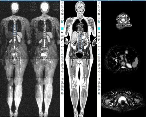 Whole Body Mri Coronal And Selective Axial Stir Sequenc Open I