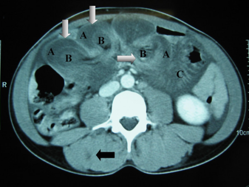 Treatment for intussusception in adults