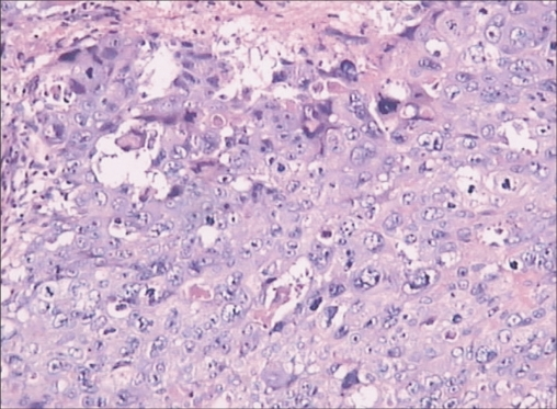 Microscopic Appearance Of The Tumor Shows A Pure Chorio 