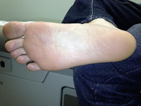 A: Tinea pedis in toe web; B: Tinea capitis showing scaring, alopecia; C: Tinea  unguium of the nail plate - Indian J Microbiol Res