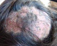 Tinea capitis: grey patch-type showing patchy alopecia with lustreless