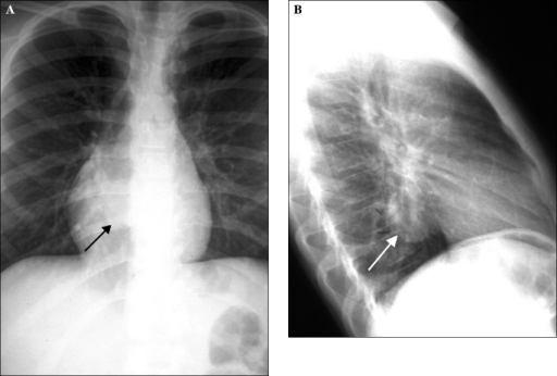 Posteroanterior chest x-ray at 9 years old (A). Lateral | Open-i