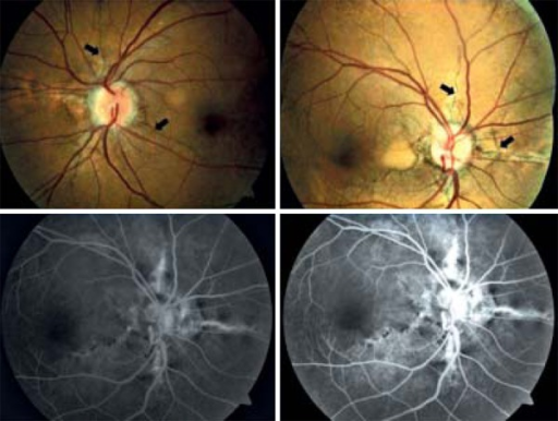 Presence Of Angioid Streaks In Retinography Arrows Which Arehyperfluorescent To Fluorescein Angiography Presence Of Angioid Streaks In Retinography Arrows Which Arehyperfluorescent To Fluorescein Angiography