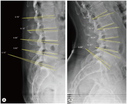 normal flexion extension cervical spine x rays