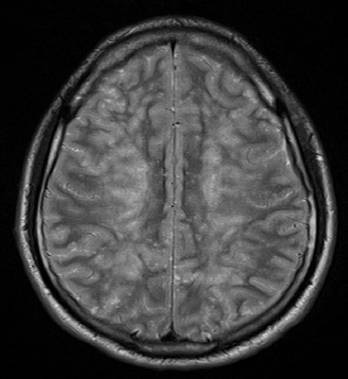 MRI of the brain showing multiple lesions consistent wi | Open-i