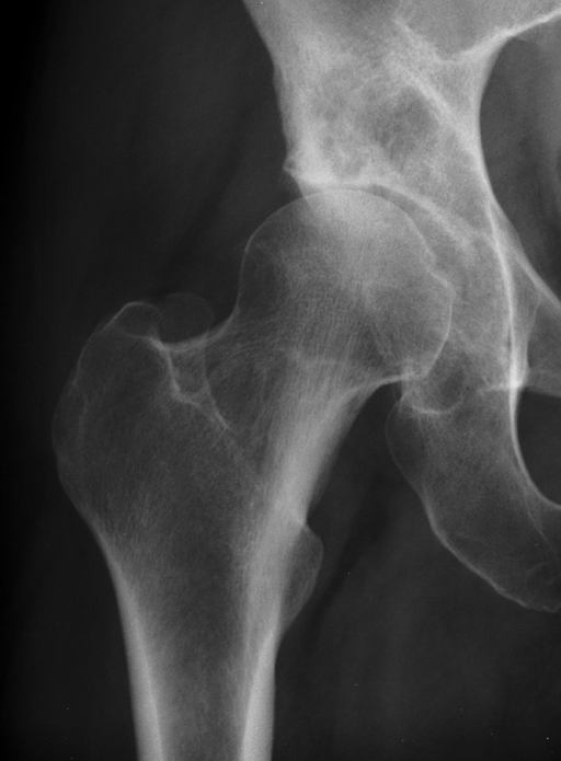 Anteroposterior x-ray of right hip with a superiorly lo | Open-i