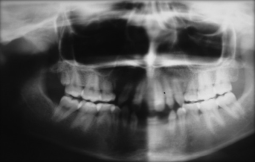 OPG shows mixed dentition | Open-i