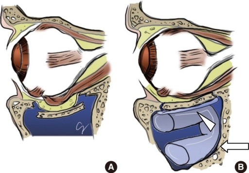 Illustrations showing the repair of the orbital floor f ...