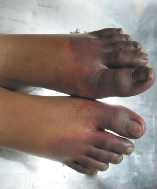 dusky-cyanosis-present-over-distal-feet-including-all-toes-and-proximal