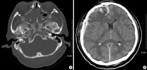 Initial Ct Scan Showing A Longitudinal Clivus Fracture Open I 7980