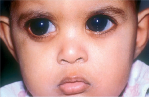 figure-10-congenital-glaucoma-open-i