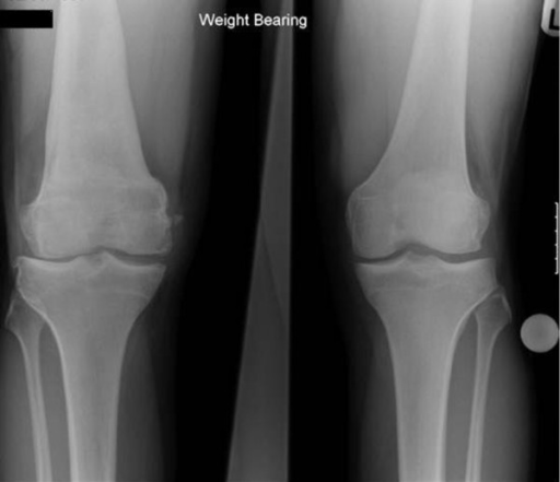 Antero-posterior weight-bearing radiograph of both knee | Open-i