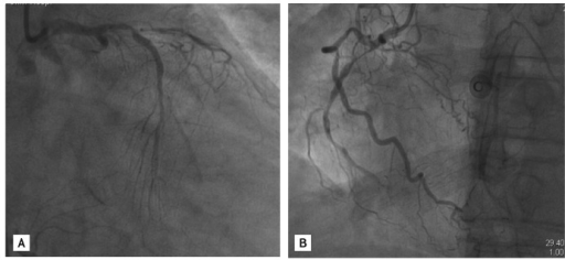 Diagnostic Coronary Angiography Shows Total Occlusion O | Open-i