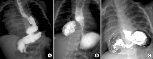 Esophagus Hiatal Hernia Surgery