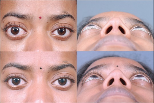mild right eye proptosis 2 3 mm managed by trans co open i proptosis