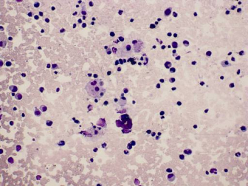 Bone marrow smear showing macrophages engulfing lymphoc | Open-i