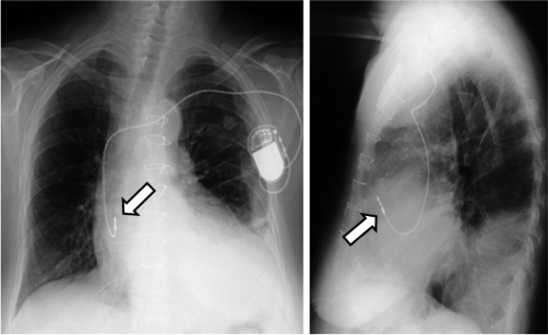 72-year-old female patient with single lead atrial pace | Open-i