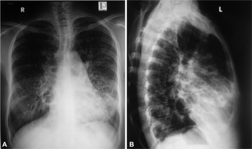 Radiologic Findings Of Chest X-ray. A: Postero-anterior 