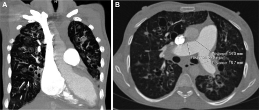 Ct Pulmonary Angiogram A Coronal View Shows Ct Pulmon Open I