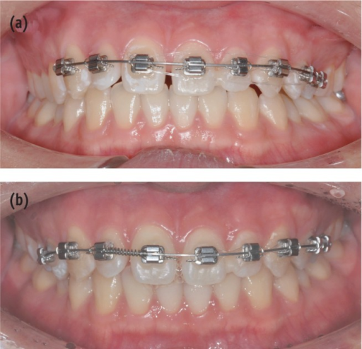 Orthodontic tooth movement. (a) A 0.16 × 0.22 inch TMA | Open-i