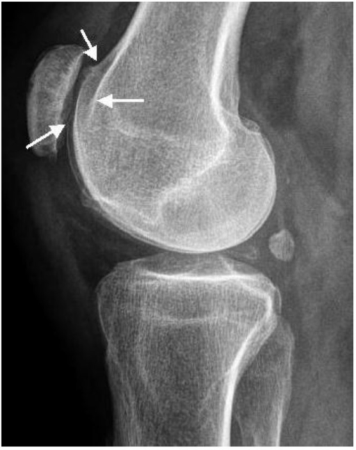 Lateral Knee Radiograph Showed Trochlear Dysplasia Inc Open I