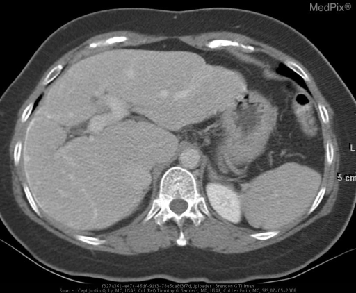 Axial CT image of the liver and magnified image of the | Open-i