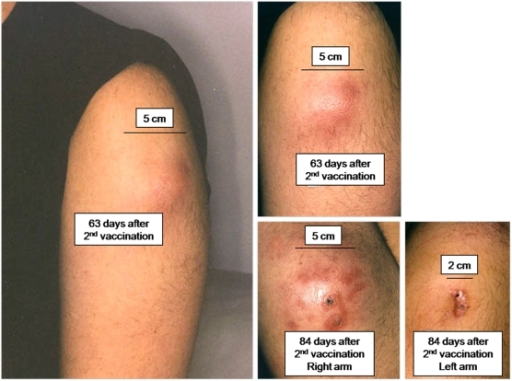 Case Report Of Local Reaction And Sterile Abscess Forma Open i