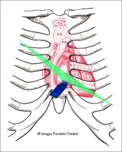 Parasternal Long Axis Ultrasound