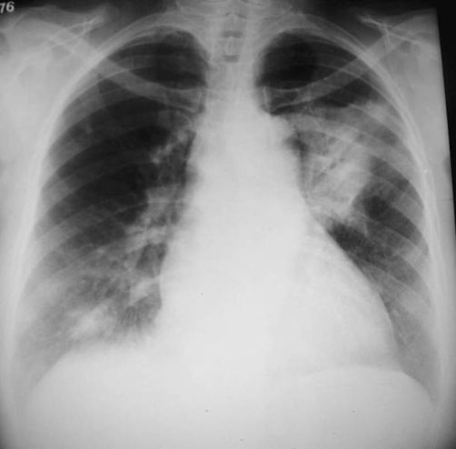 Chest X Ray Shows A Large Consolidation With Air Bronch Open I