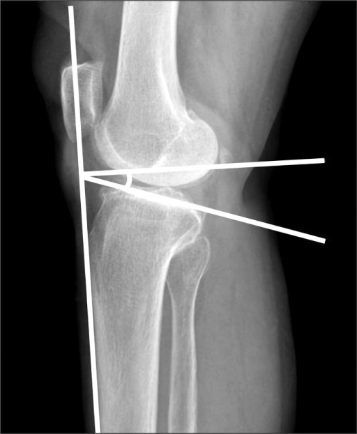 A method of measuring the posterior tibial slope in thi | Open-i