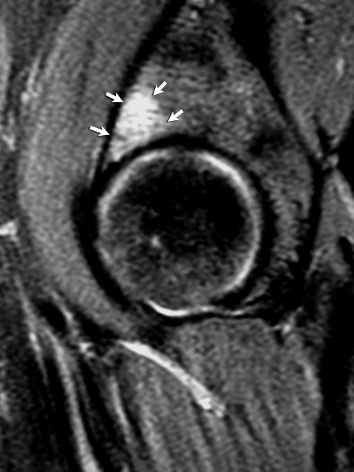 A Sagittal T2 Weighted Mri Of A Right Hip Subchondral Open I