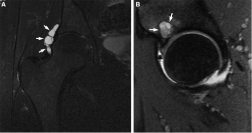 Hip Labral Cyst Caused By Psoas Impingement Arthroscopy Porn Sex Picture