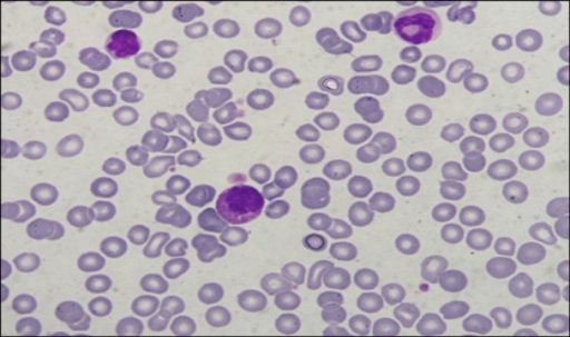 Peripheral blood smear showing occasional promyelocyte | Open-i