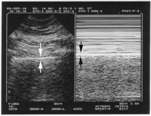 lung sliding sign – m mode pneumothorax – Shotgnod